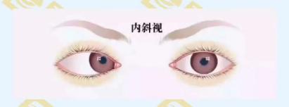 什么是調(diào)節(jié)性內(nèi)斜視？