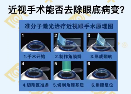 近視手術能否去除眼底病變？