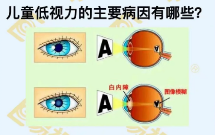 兒童低視力主要病因有哪些？
