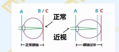 哪個年齡近視度數(shù)最容易增長？