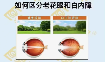 如何區(qū)分老花眼和白內(nèi)障？