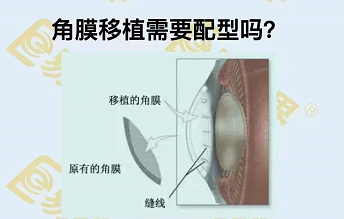 角膜移植需要配型嗎？