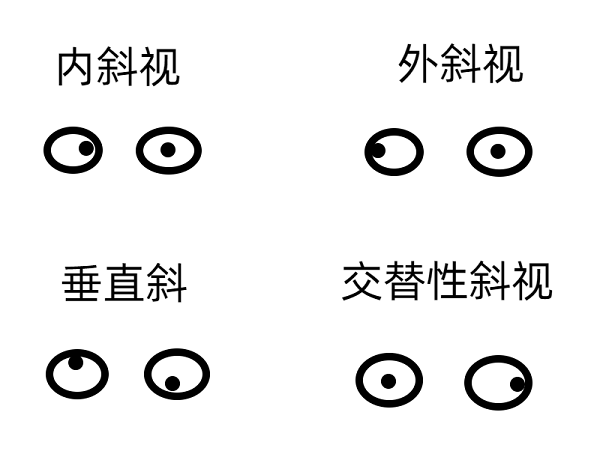 斜視早期的癥狀有哪些？